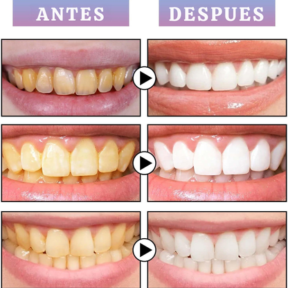 Blanqueador dental UV Consigue una sonrisa perfecta en solo 20 minutos.